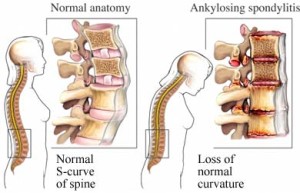 ankylozujici-spondylitida